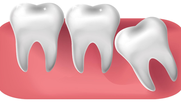 When Should You Have Your Wisdom Teeth Removed?